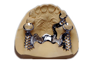 Dental Crowns & Bridges